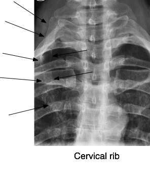 Cervical rib casefile shows the rudimentary ones are oft of little ...