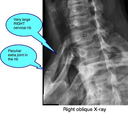 Cervical rib casefile shows the rudimentary ones are oft of little ...