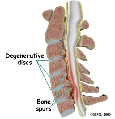 Symptoms of cervical stenosis are often baffling to all clinicians.